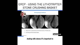 ERCP  Using the Lithotripter Stone Crushing Basket [upl. by Pump]