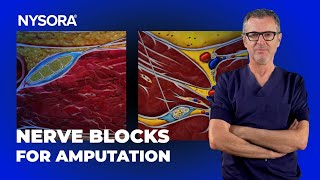 Sciatic  Femoral Nerve Blocks for AKA Amputation [upl. by Arten]