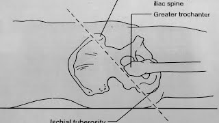 Nelatons line  Special test to check hip dislocation or coxa vara [upl. by Ahsot919]