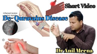 Dequervains disease  dequervains tenosynovitis  thumb pain  Dequervains syndrome testin hindi [upl. by Helman381]