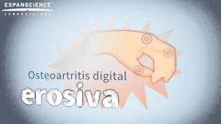 La osteoartritis digital erosiva [upl. by Nednil]