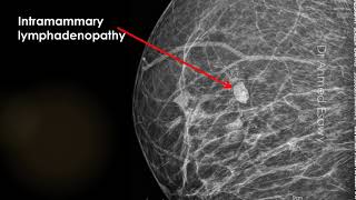 CASE 538 mammography Intramammary lymphadenopathy [upl. by Bouchard706]