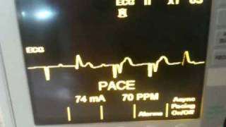 3rd Degree Heart Block paced at 74mA per 2010 ACLS Guidelines [upl. by Buderus]