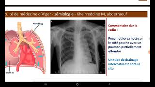 UE1 Sémiologie Respiratoire  Les Signes Fonctionnels Part 2 Les Douleurs thoraciques  La toux [upl. by Haem]