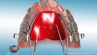 ES Ortho and Distal Jet Appliance [upl. by Rennug104]