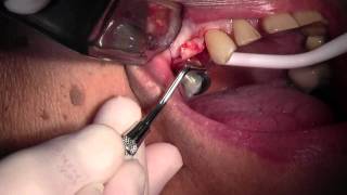 CAMLOG Implant Placement 5 Site Flap Design amp Pilot Hole [upl. by Libna]