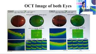 AIOCMTC2 2023 APOS Retina PPS FP673 Dr SIRIPURAPU CASE OF FOVEAL HYPOPLASIA WITH NYSTAGMUS [upl. by Germano953]