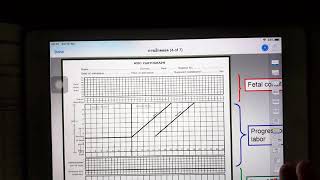 WHO partograph 2 [upl. by Battat]
