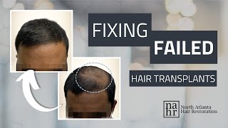 Fixing Failed Hair Restoration Procedures [upl. by Emmi]