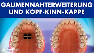 Kieferorthopädie  Gaumennahterweiterung und KopfKinnKappe © [upl. by Nayt]