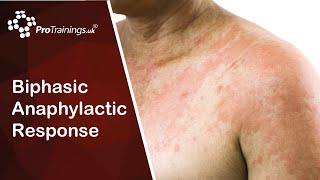 Biphasic Anaphylactic Response [upl. by Sivolc572]