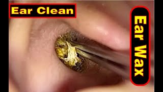 Ear wax removal amp Ear Cleaning （9） [upl. by Elimay]