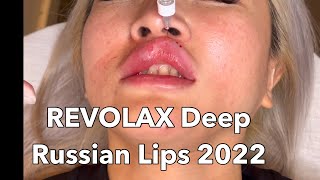 Beautiful Lips 2022  Lips Filler  Russian lips and REVOLAX Deep [upl. by Gnay987]