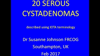 serous cystadenomas YouTube Feb 2017 [upl. by Lathan]