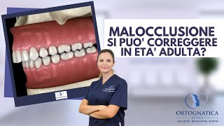 Malocclusioni dentoscheletriche è possibile correggerle in età adulta [upl. by Ahseyd]