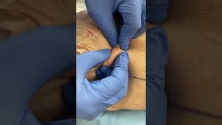 IMG 2540 PUSHING OUT A SEBACEOUD CYST [upl. by Callahan]