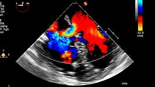 Atrial Septal Defect Primum Echocardiography [upl. by Jarvis]