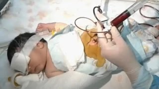 Blood Exchange Transfusion  Neonatal Jaundice [upl. by Brose550]