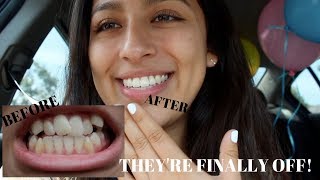 GETTING MY BRACES OFF VLOG  2017 [upl. by Nebur]