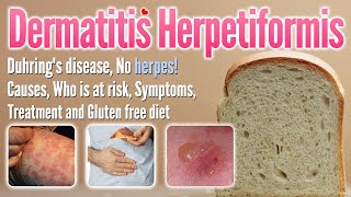 Dermatitis herpetiformis Causes Symptoms Treatment and glutenfree diet list  Duhring’s disease [upl. by Malti]