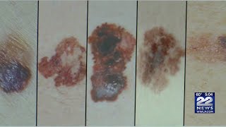 Melanoma Monday What are the warning signs of skin cancer [upl. by Eradis347]