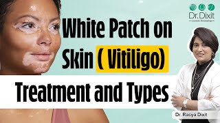 White Patches on Skin  Vitiligo Skin Disease Treatment  Types of vitiligo  Dr Rasya Dixit [upl. by Lamar]