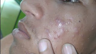 sac be spa blackheads elderly 2024  sac be spa old age blackheads 2024  sac be spa face scrub 993 [upl. by Oht845]