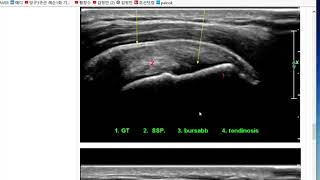 ultrasound exam of mild impingement [upl. by Mera]