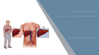 How Successful Is Liver Transplantation  Liver Transplantation  Manipal Hospitals [upl. by Anayet]