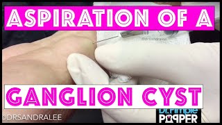 Aspiration of a ganglion cyst [upl. by Arleen]