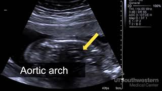 Understanding your fetal ultrasound [upl. by Euqinomahs]