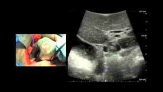 BK Medical Intraoperative Ultrasound Imaging of the Liver [upl. by Aniratak669]