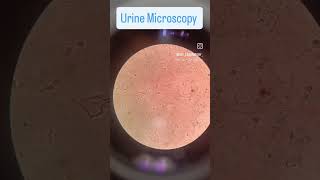 Urine Microscopy Picture Identify The Name of the cells and comment below 👇👇 pathology lab [upl. by Botti]