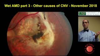 Other causes of choroidal neovascular membranes  wet AMD  Part 3 [upl. by Barta]