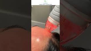 Microneedling amp PRF Therapy for Flawless Skin  Dr Gautam Rekhi  Skin amp Hair Specialist [upl. by Rogers]