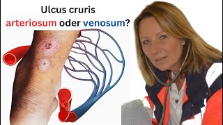 Was ist der Unterschied zwischen einem ulcus cruris arteriosum und venosum [upl. by Kazmirci43]