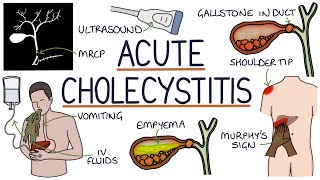 Understanding Acute Cholecystitis [upl. by Attelahs]