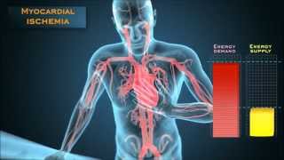 Understanding the energetic mechanisms that cause angina pectoris [upl. by Norag]