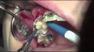 Mini Implant quotMegagenquot [upl. by Tracy]