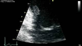 RUPTURE CHORDAE POSTEROMEDIAL PAPILARY MUSCLE  MR PROLAPSE [upl. by O'Connor]