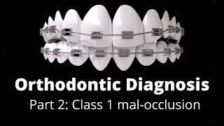 orthodontics Treatment planning Part 1 Class 1 malocclusion Orthodontic Courses Tutorial Lecture [upl. by Namron671]