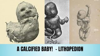 The Stone Baby Phenomenon Lithopedion [upl. by Finstad]