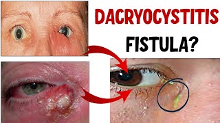 DACRYOCYSTITIS Lacrimal Sac Infection Stages Complications and Treatment [upl. by Elbys]