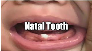 Natal Tooth  Baby born with a Tooth  Newborns  Neonatology  Doctor Xydi [upl. by Donny904]