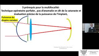 Chirurgie de la cataracte  évolution technologique des implants intraoculaires multifocaux [upl. by Esom]