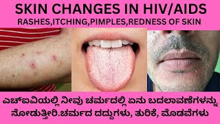 HIVAND AIDS SYMPTOMS IN KANNADASKIN CHANGES WE SEEIN HIV OR AIDS PATIENTSKIN RASHEITCHING IN HIV [upl. by Resa]