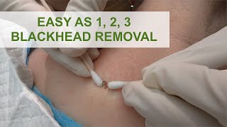 Easy as 1 2 3 Blackhead Removal  Dr Derm [upl. by Nuoras]