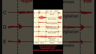 aortic regurgitation murmur apex beat mcqs important points [upl. by Fabrienne831]