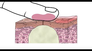 Using glycolic acid to help clear acne  Acneorg [upl. by Olivie984]