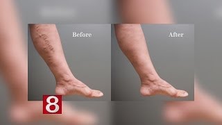 Removing Varicose Veins [upl. by Ydda]